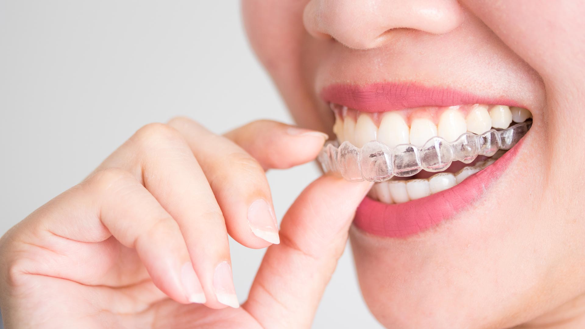 Invisalign e alinhador invisível na CDS Odontologia Digital